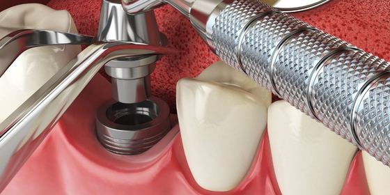 Implante dental en modelo 3D