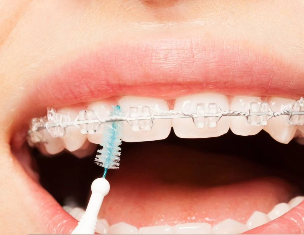 Cepillo interdental en una boca con ortodoncia
