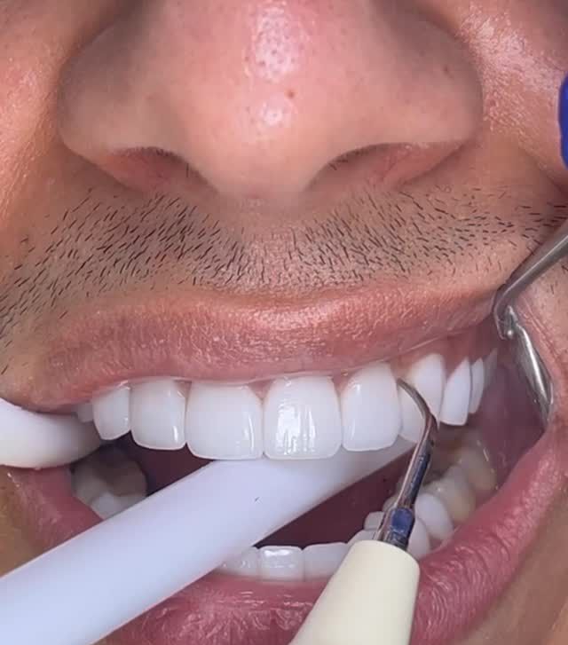 Limpieza dental profesional